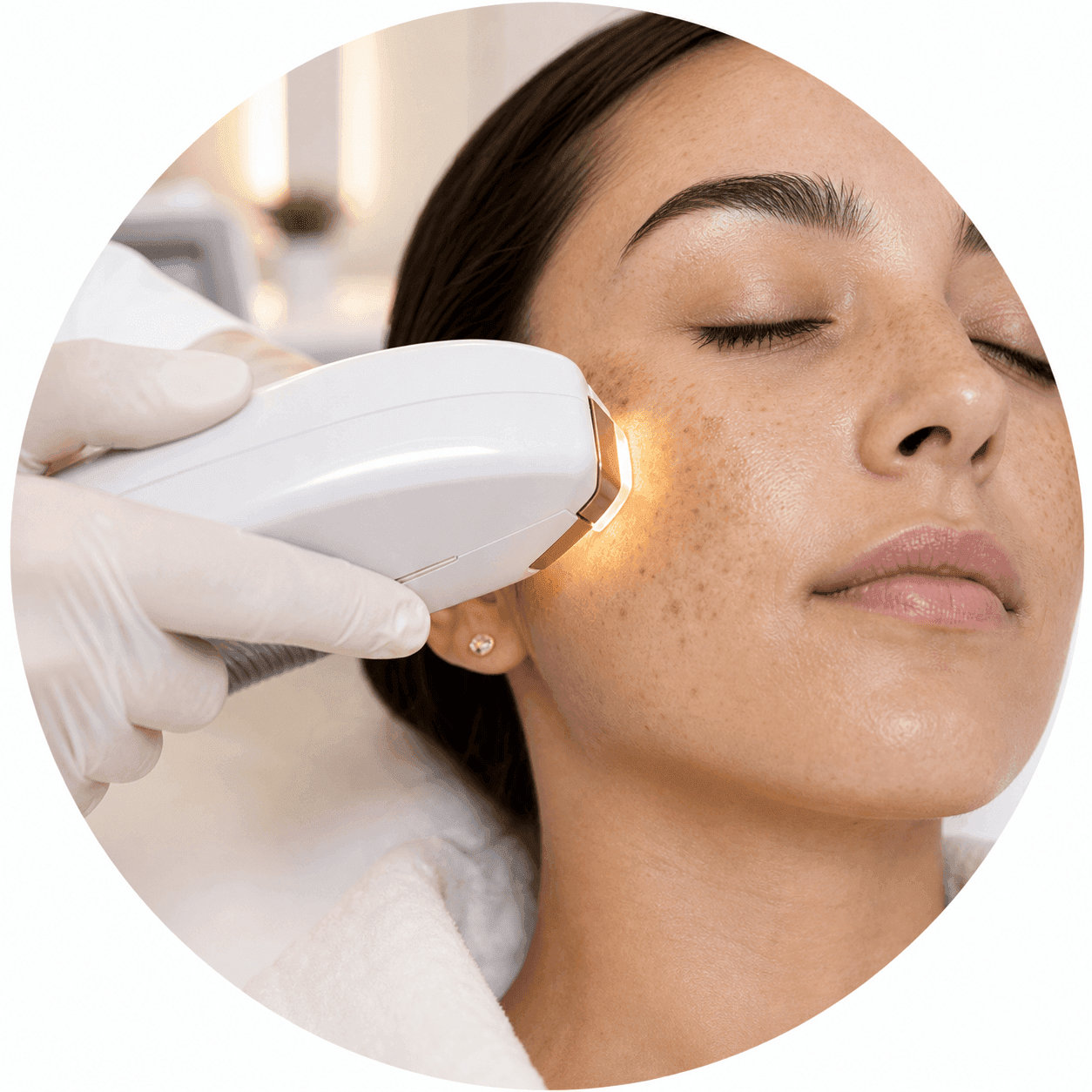 IPL treatment for pigmentation and uneven skin tone