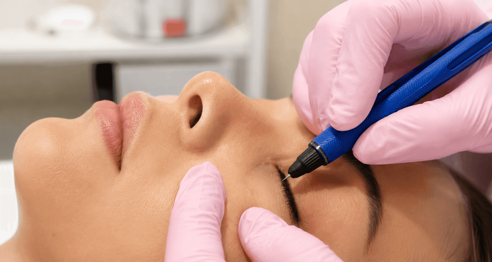 Skin Tag, Warts and Spider Vein Removal