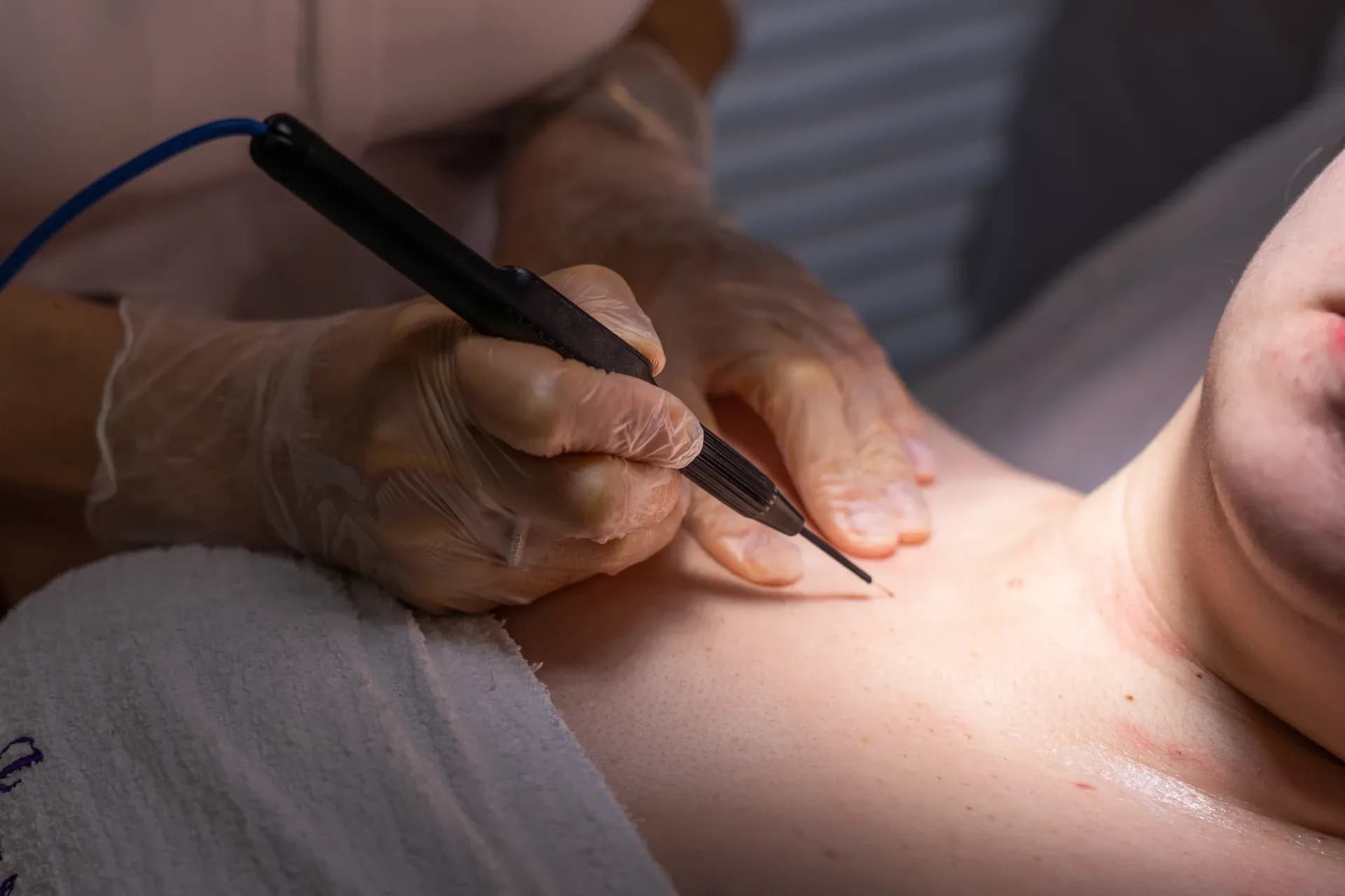 Close-up of skin tag removal procedure for smoother, clearer skin